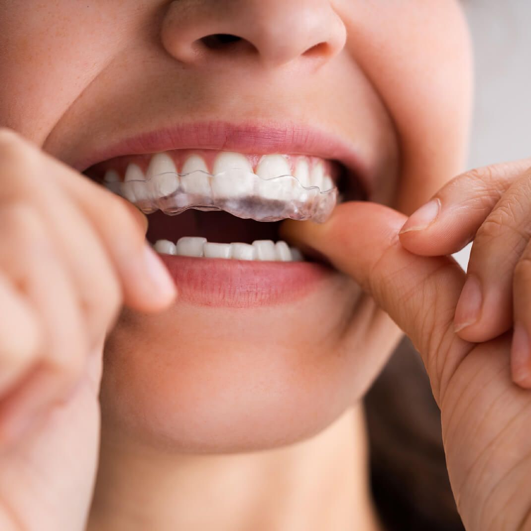 Care Tips for Candid Aligners