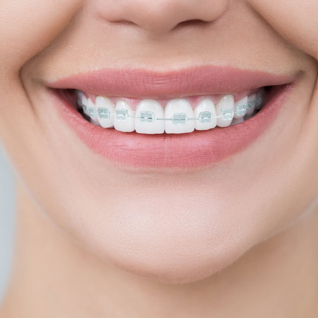 Clear Braces