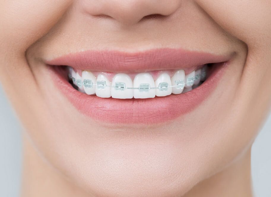 Ceramic Braces | National Orthodontists