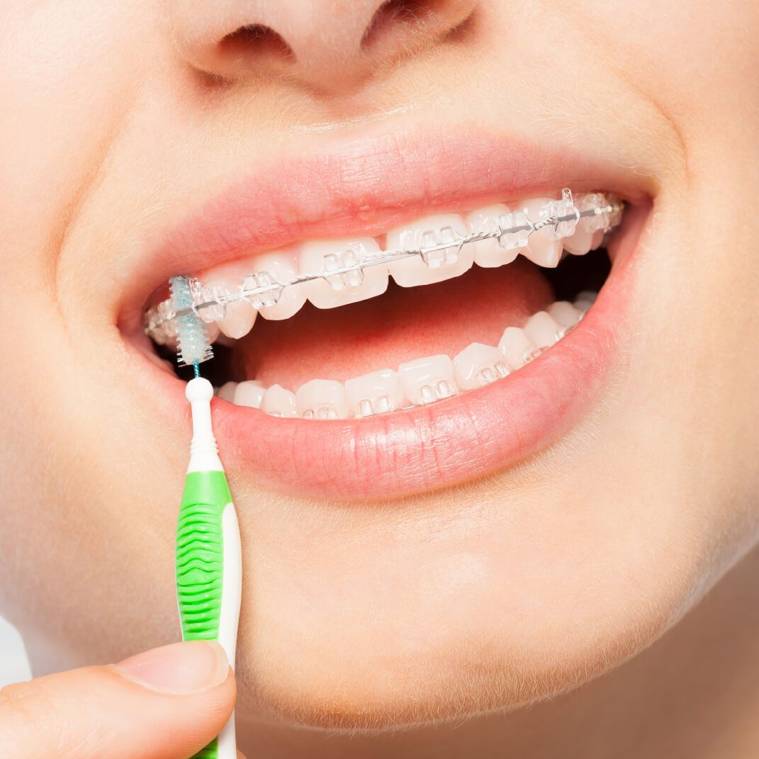 Care Tips for Clear Braces Flushing