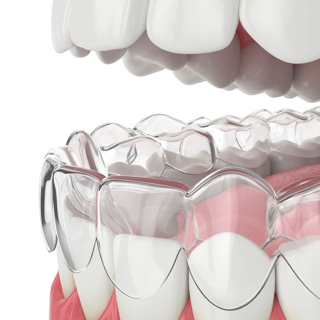 Invisalign Free Consultation | National Orthodontics