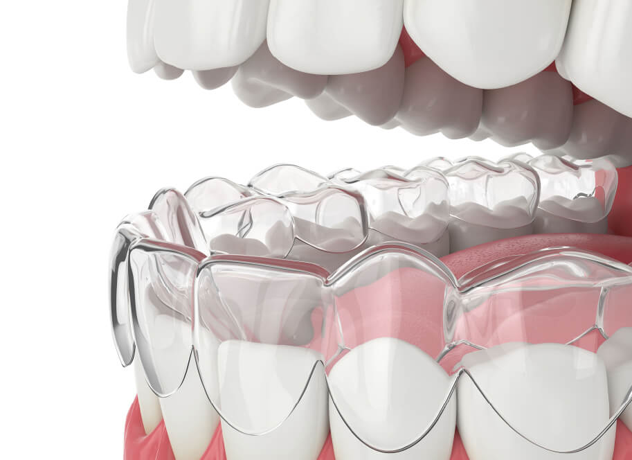 Invisalign Free Consultation | National Orthodontics