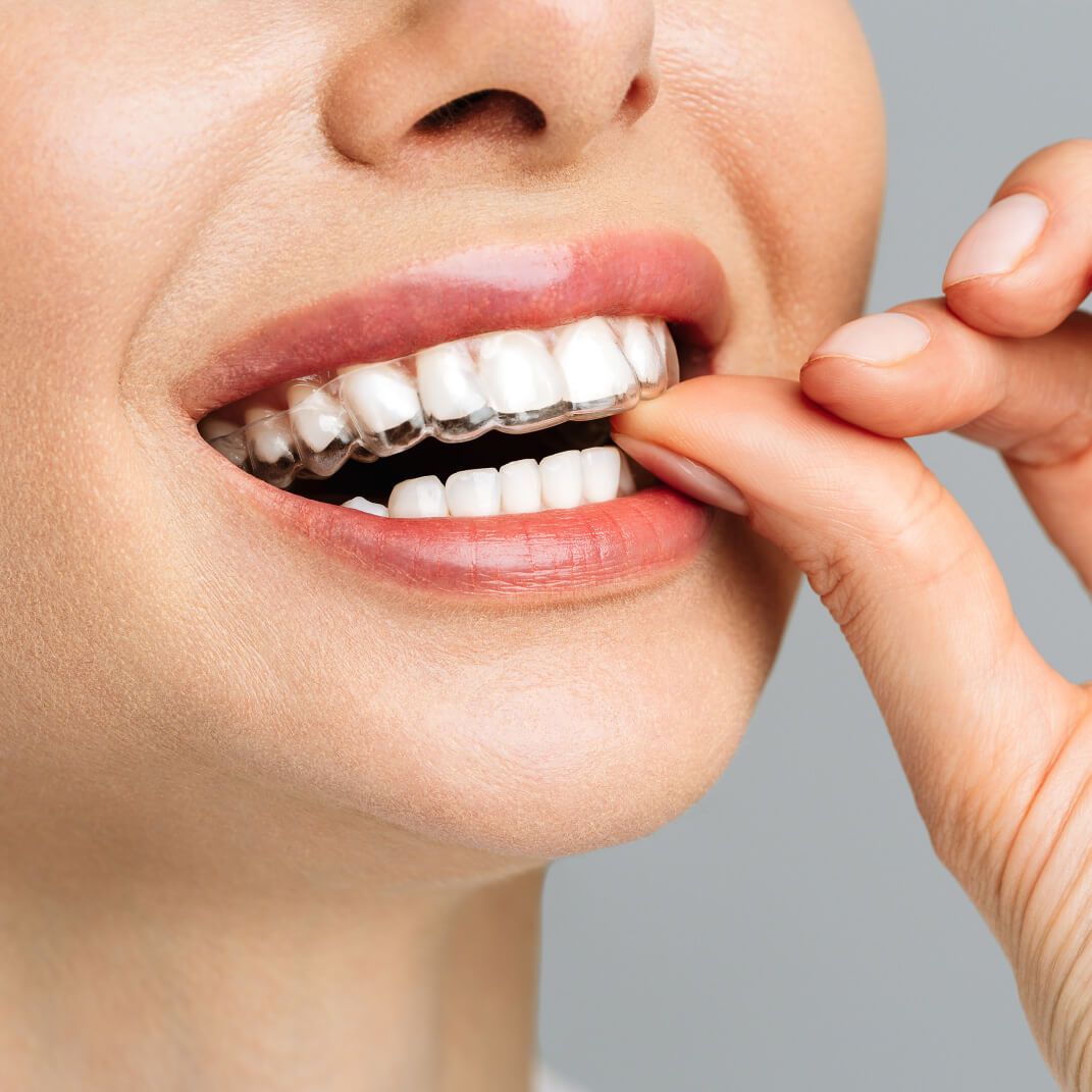 Care Tips for Invisalign Kings Highway