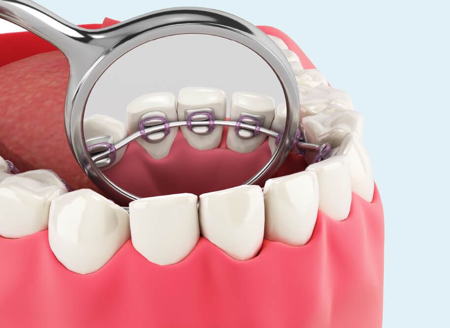 Lingual Braces | National Orthodontists