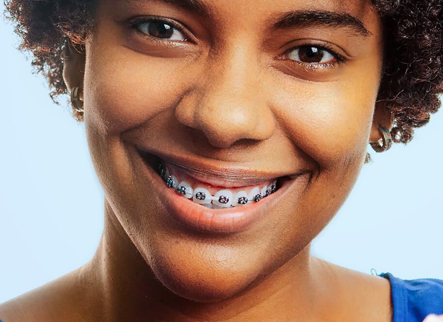 Metal Braces | National Orthodontics